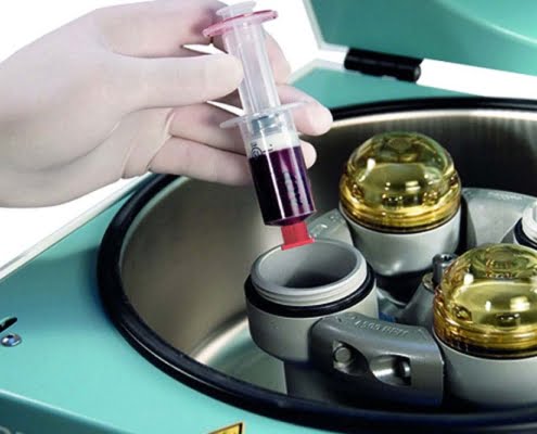 ACP bloedplasma bereiding centrifuge Centrifuge met bloedbuisjes voor de bereiding van ACP bloedplasma: het bloed wordt gecentrifugeerd om een concentraat van bloedplaatjes en groeifactoren te verkrijgen