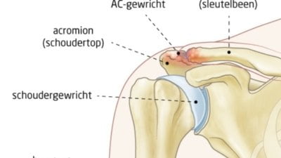 osteofyten AC gewricht