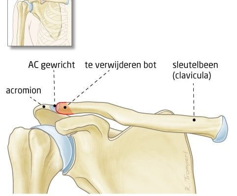 laterale clavicularesectie