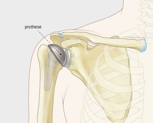 Anatomische illustratie van een schouderprothese: de metalen schouderkop is geplaatst in de bovenarm, de kunststof kom op het schouderblad, bij intacte schouderpezen