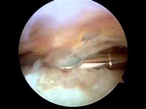 Arthroscopisch beeld van een bursectomie: verwijdering van de ontstoken slijmbeurs via een kijkoperatie