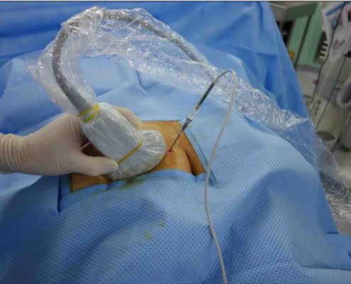 Echogeleide zenuwblokkade van de schouder: de echokop en naald worden echogeleid geplaatst voor een PRF-behandeling van de nervus suprascapularis bij chronische schouderpijn