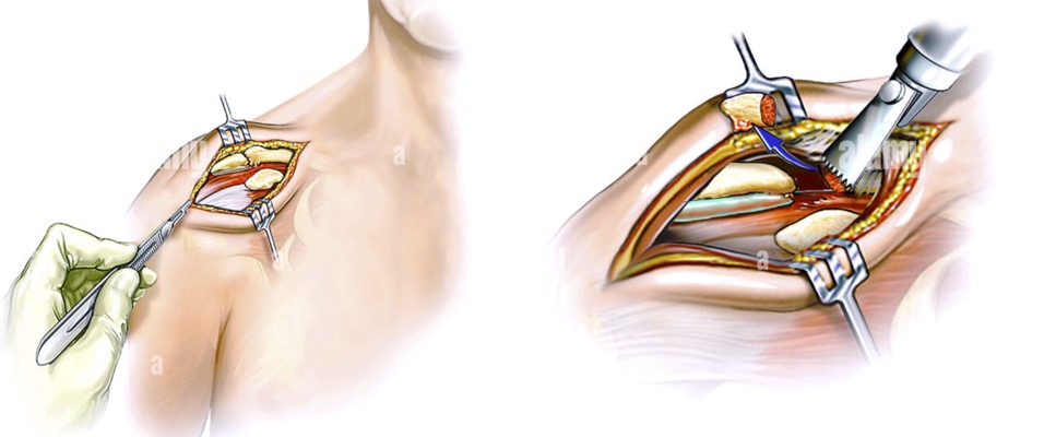 Laterale clavicula resectie open echozorg