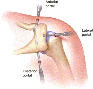 laterale clavicula resectie kijkoperatie Orthozorg