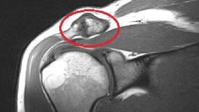 AC gewricht artrose MRI