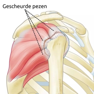 Anatomische illustratie van een grote cuff ruptuur: meerdere gescheurde pezen zijn zichtbaar met stippellijnen die de scheuring aangeven
