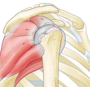 Anatomische illustratie van een massale cuff ruptuur: meerdere rotator cuff pezen zijn afgescheurd van de schouderkop, de rode pijlen tonen de richting van terugtrekking