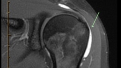 </p><p>Op een MRI is de slijmbeurs wel goed zichtbaar — zeker als er vocht in zit. Maar voor de diagnose en behandeling van een slijmbeursontsteking voegt een MRI zelden iets toe aan wat we al zien op echo.</p><p>” width=”400″ height=”225″ /></p><p>Maar voor de diagnose en behandeling van een slijmbeursontsteking voegt een MRI zelden iets toe aan wat we al zien op echo.</p><h4>Waarom echo beter is bij slijmbeursklachten</h4><p>De slijmbeurs, pezen en kalkafzettingen liggen aan de buitenkant van de schouder, niet verscholen achter bot. Daardoor brengt een goede echo deze structuren scherper in beeld dan een MRI. De resolutie is hoger en u kunt het beeld sterk vergroten.</p><p>Bovendien biedt echo voordelen die MRI niet heeft:</p><ul><li><strong>Dynamisch onderzoek:</strong> we zien de slijmbeurs en pezen tijdens het bewegen. Klemmen ze? Glijden ze soepel?</li><li><strong>Direct resultaat:</strong> tijdens hetzelfde consult diagnose én behandeling</li><li><strong>Vergelijking:</strong> we kunnen direct de gezonde schouder ernaast leggen</li></ul><h4>Het enige nadeel van echo</h4><p>Met echo kunnen we niet ín het schoudergewricht kijken. Geluidsgolven gaan niet door bot heen. Maar gewrichtsaandoeningen veroorzaken eigenlijk geen slijmbeursproblemen. Voor een slijmbeursontsteking mist u dus niets.</p><h4>Wanneer vragen we wél een MRI aan?</h4><ul><li><strong>Vermoeden van een labrumscheur:</strong> het labrum (kraakbeenrand) ligt achter de botkop en is niet zichtbaar op echo</li><li><strong>Intra-articulaire laesie:</strong> schade bínnen het gewricht die we met echo niet kunnen beoordelen</li><li><strong>Operatieplanning:</strong> bij een schouder pees scheur (rotator cuff) die mogelijk geopereerd moet worden</li><li><strong>Langdurig beloop zonder verbetering:</strong> om andere oorzaken uit te sluiten</li></ul><div style=
