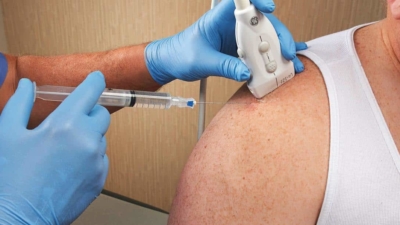 Echogeleide cortisone-injectie bij tendinitis calcarea: de naald wordt onder echogeleiding in de slijmbeurs geplaatst ter hoogte van de kalkafzetting in de schouderpees