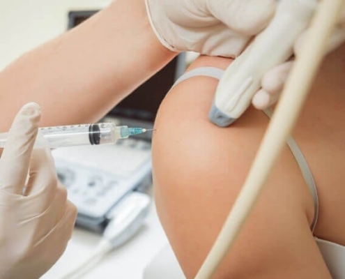 frozen shoulder injectie Echogeleide cortisone-injectie bij frozen shoulder: de naald wordt onder echogeleiding in het schouderkapsel geplaatst