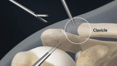 laterale clavicula resectie Arthroscopische laterale clavicula resectie: chirurgische instrumenten verwijderen het uiteinde van het sleutelbeen (clavicle) via kleine insteekopeningen in de schouder