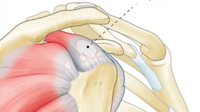tendinitis-calcarea