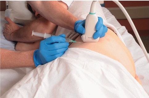 frozen shoulder injectie Echogeleide cortisone-injectie bij slijmbeursontsteking heup: naald en echosonde zichtbaar aan de buitenkant van de heup